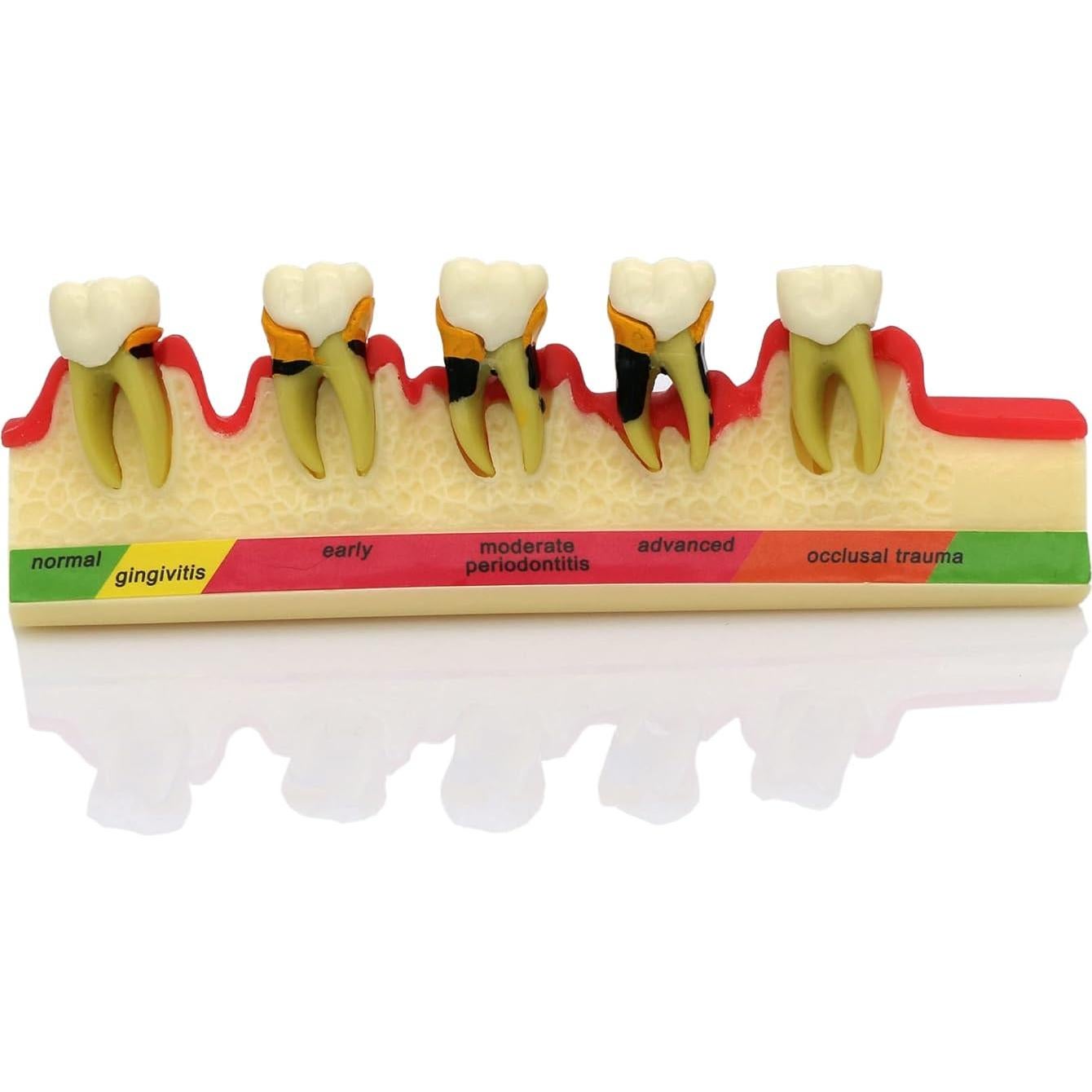 Modelo Typodont Dentalmall 4010 para Enfermedad Periodontal