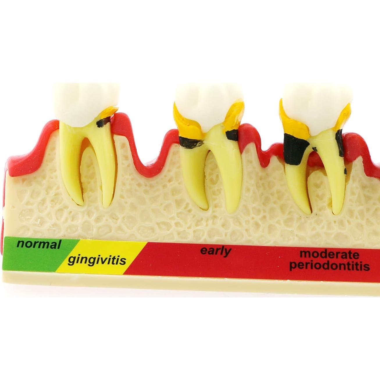 Modelo Typodont Dentalmall 4010 para Enfermedad Periodontal
