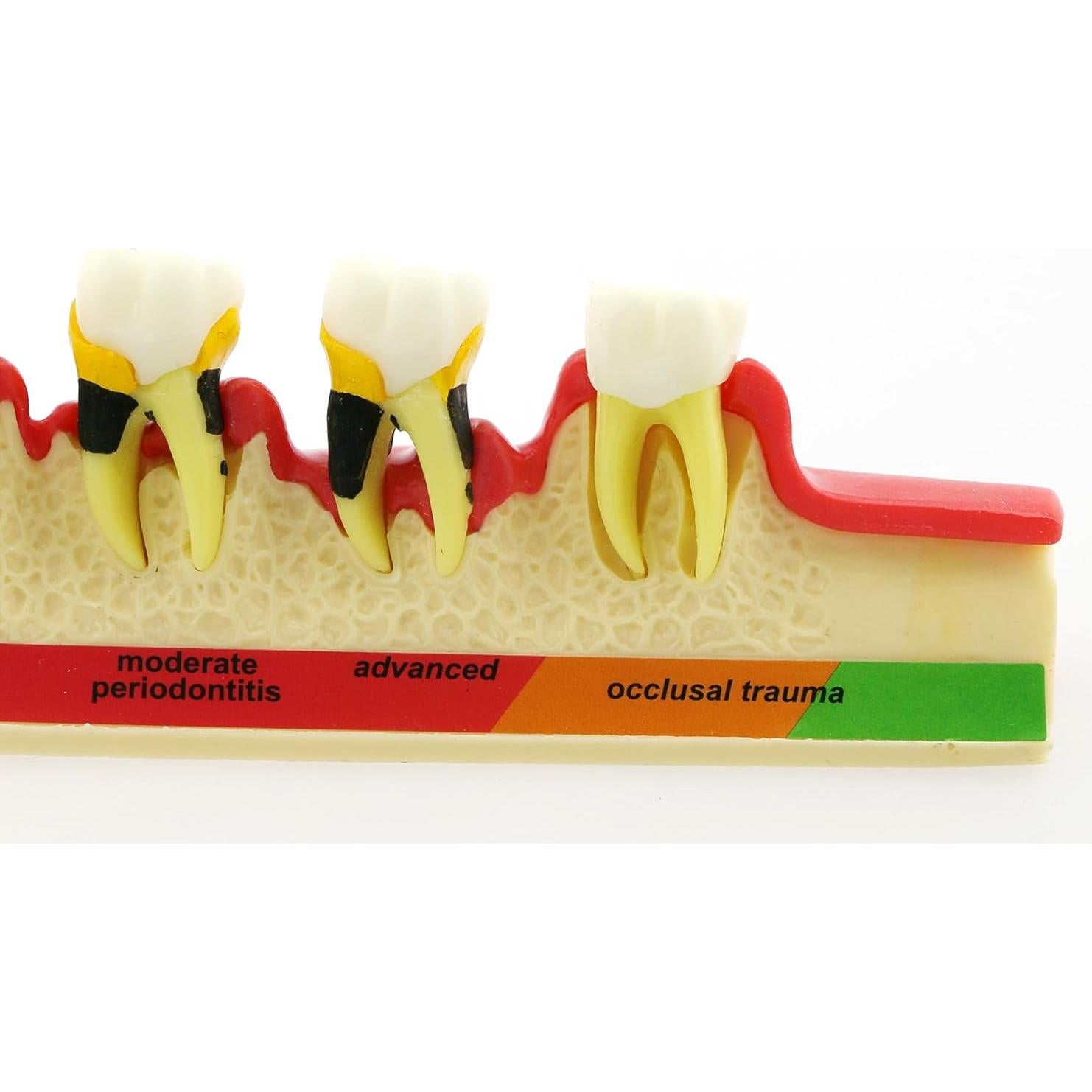 Modelo Typodont Dentalmall 4010 para Enfermedad Periodontal