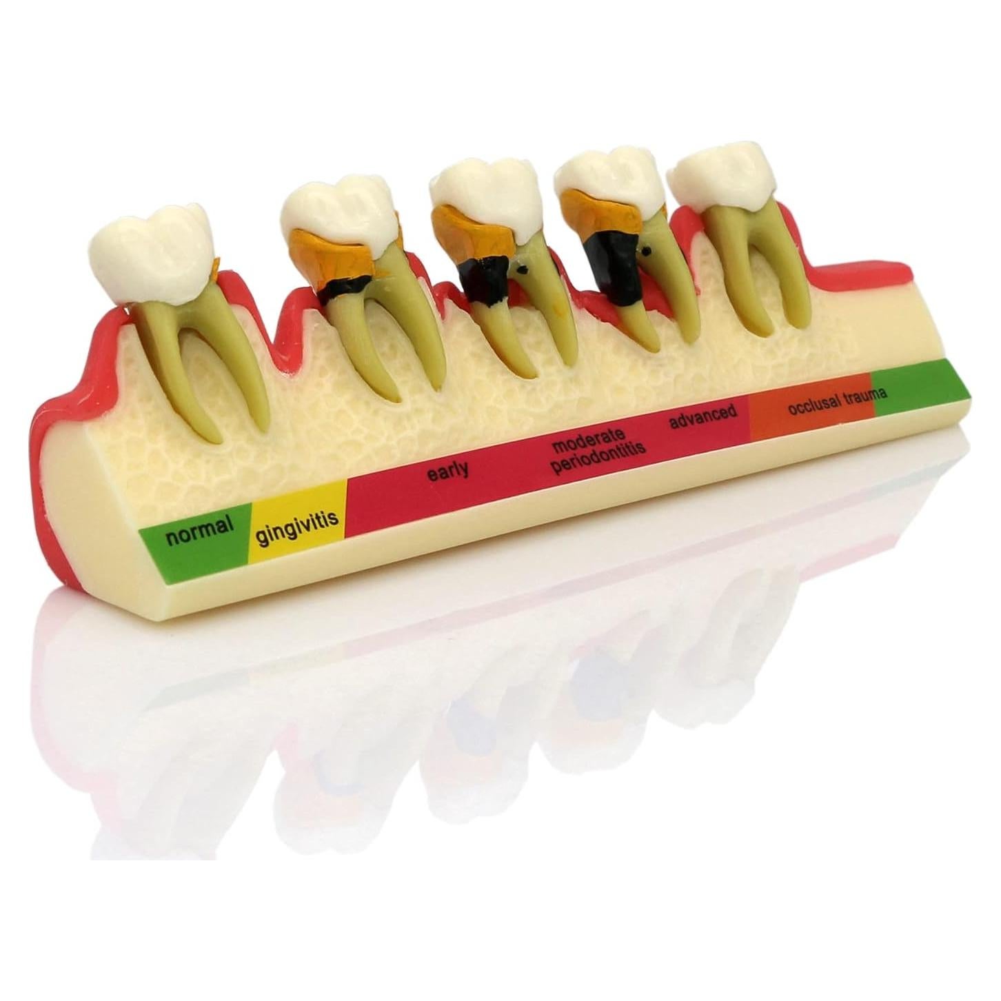 Modelo de Enfermedad Periodontal Septan Dental 5 Etapas