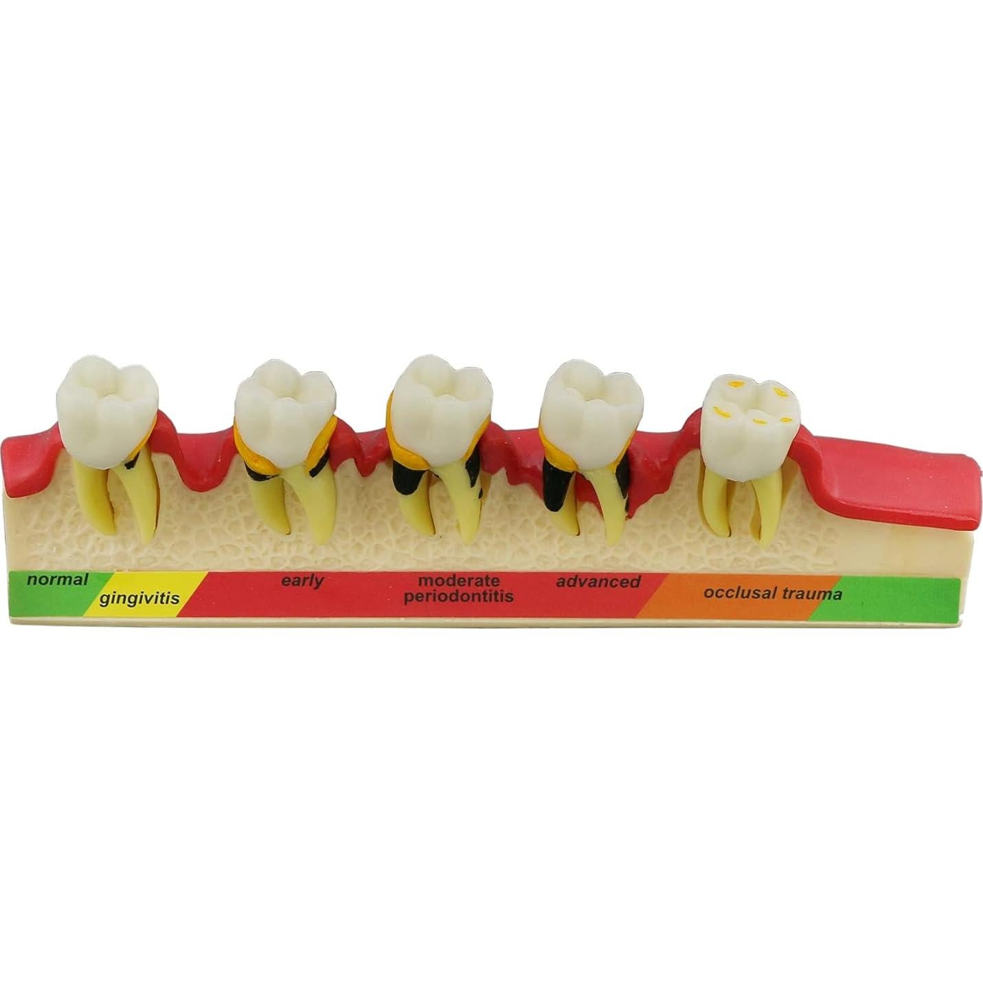 Modelo de Enfermedad Periodontal Septan Dental 5 Etapas