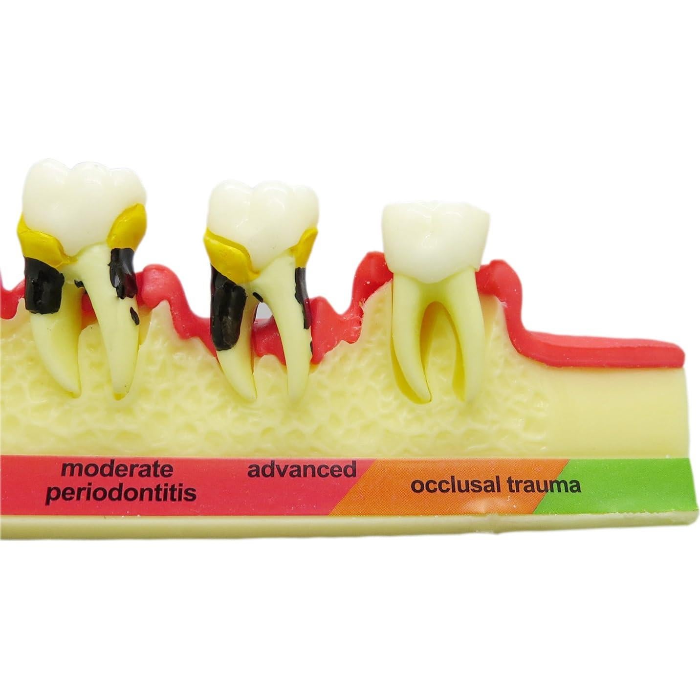 Modelo de Enfermedad Periodontal Septan Dental 5 Etapas