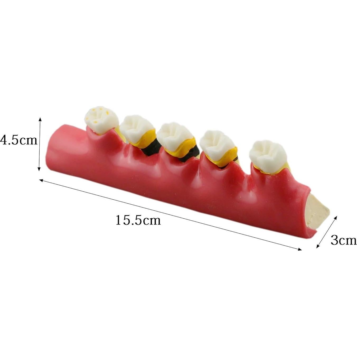 Modelo de Enfermedad Periodontal Septan Dental 5 Etapas