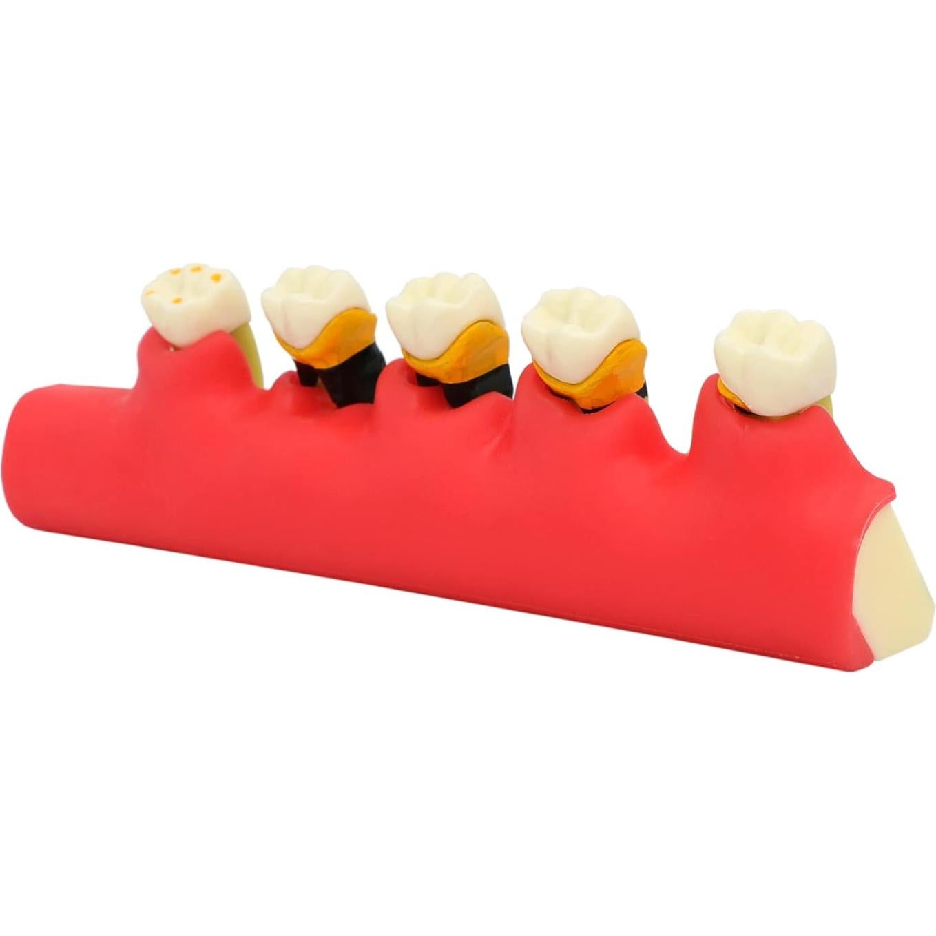 Modelo de Enfermedad Periodontal Septan Dental 5 Etapas