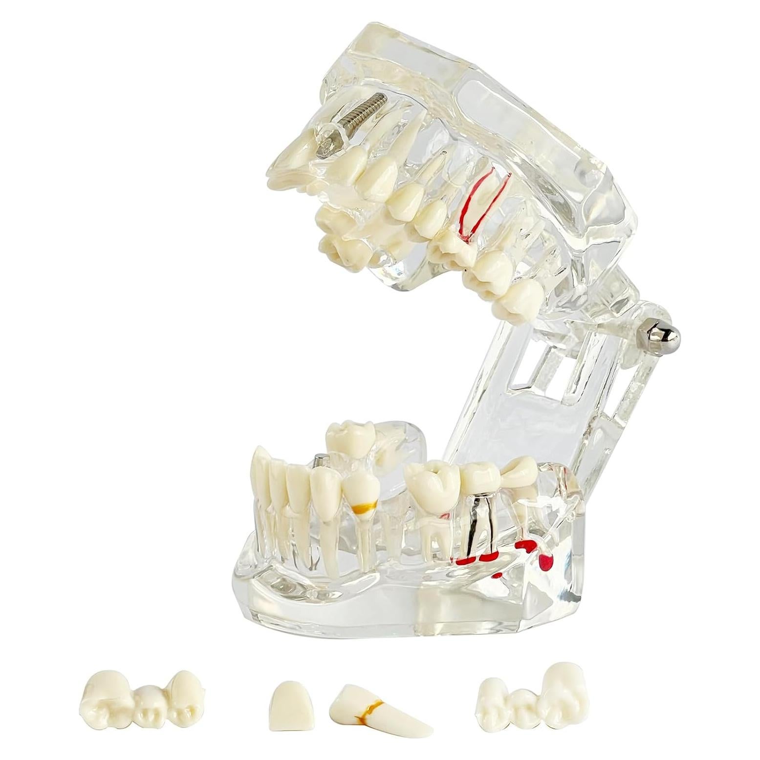 Modelo Dental Transparente Patológico Ceonam - Tamaño Real