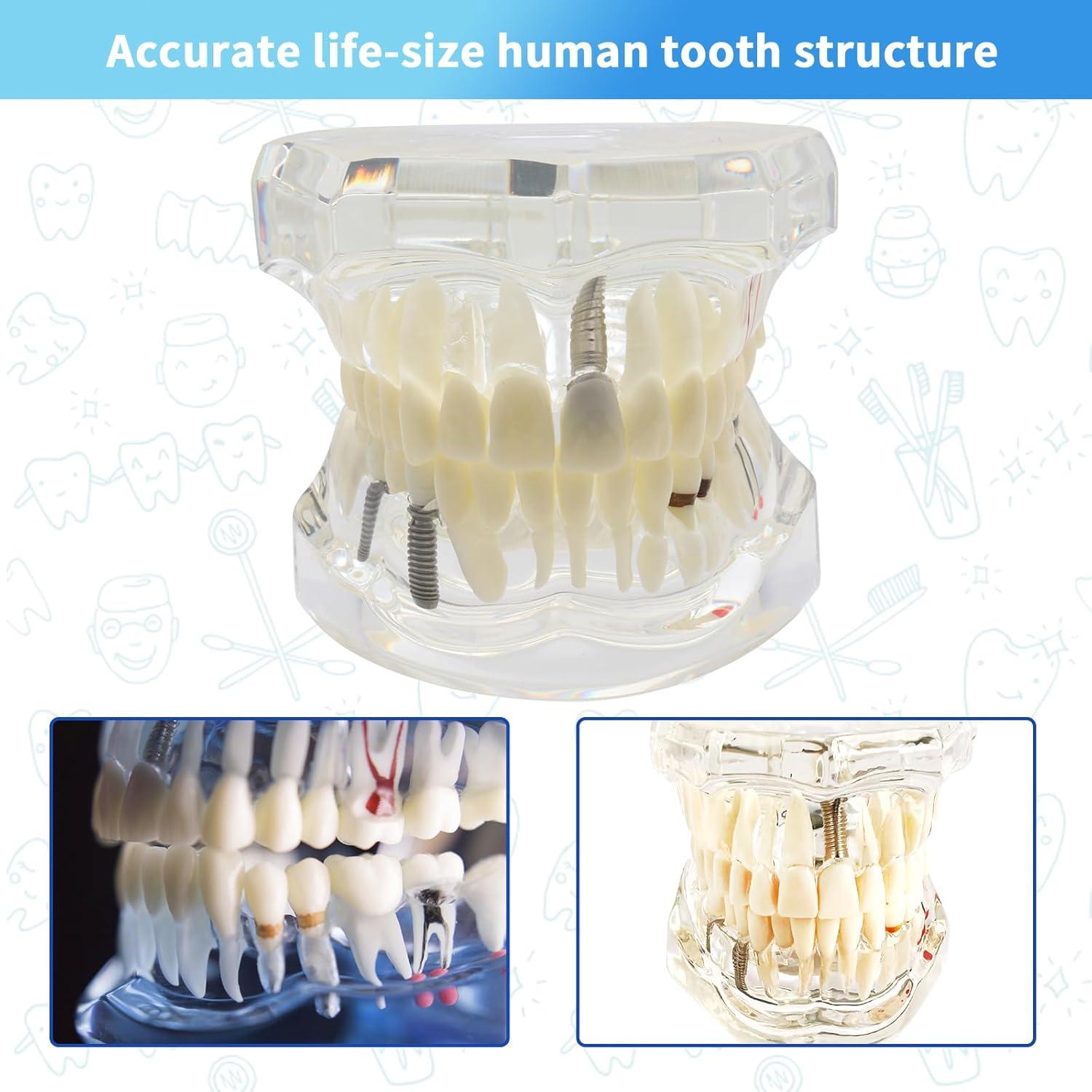 Modelo Dental Transparente Patológico Ceonam - Tamaño Real