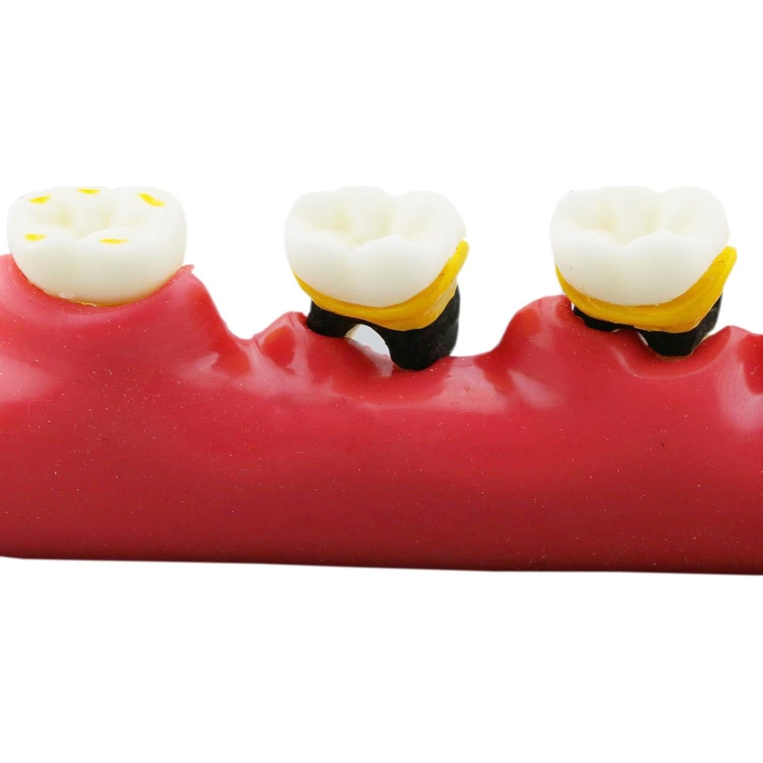 Modelo Typodont Dental M4010 para Enfermedad Periodontal