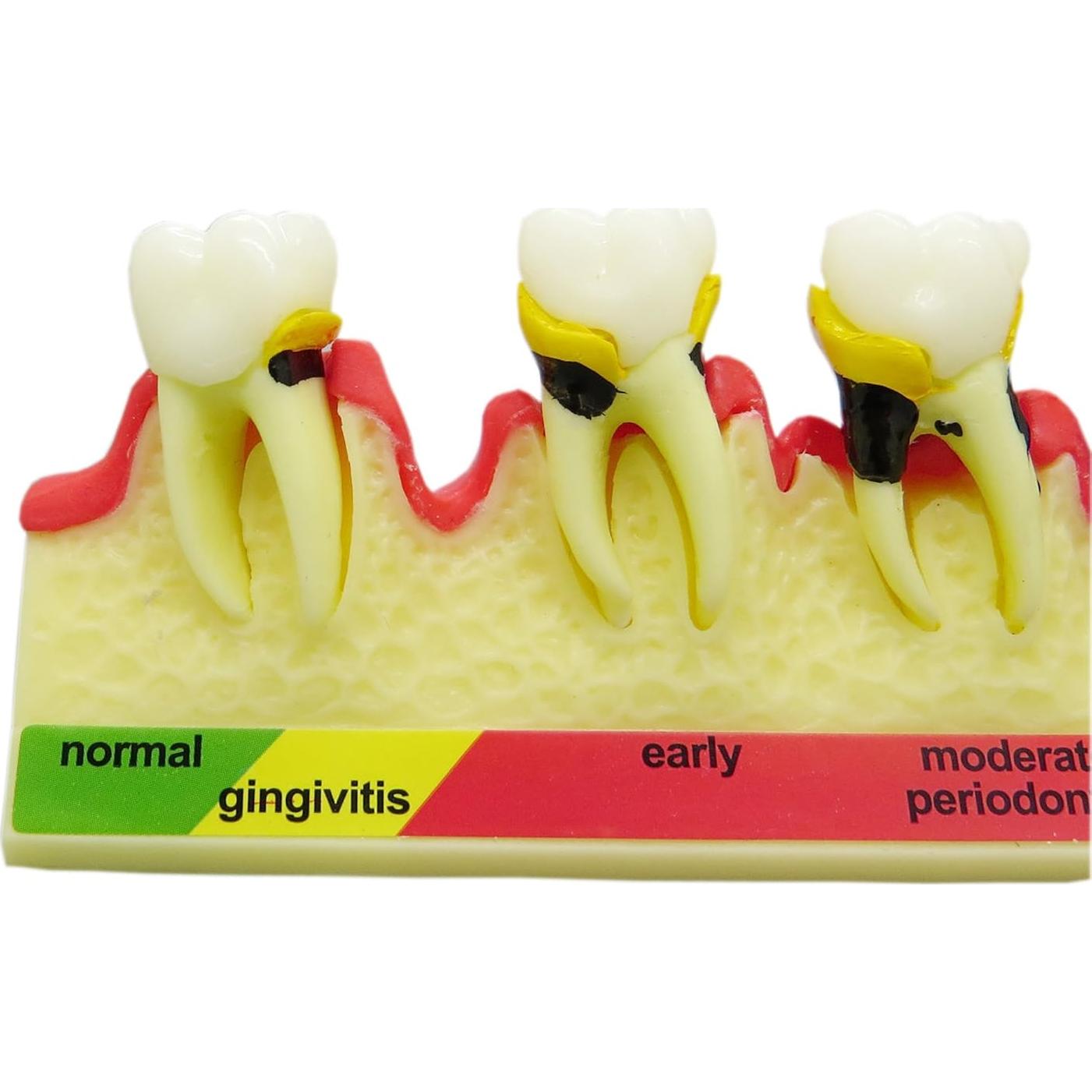 Modelo Typodont Dental M4010 para Enfermedad Periodontal