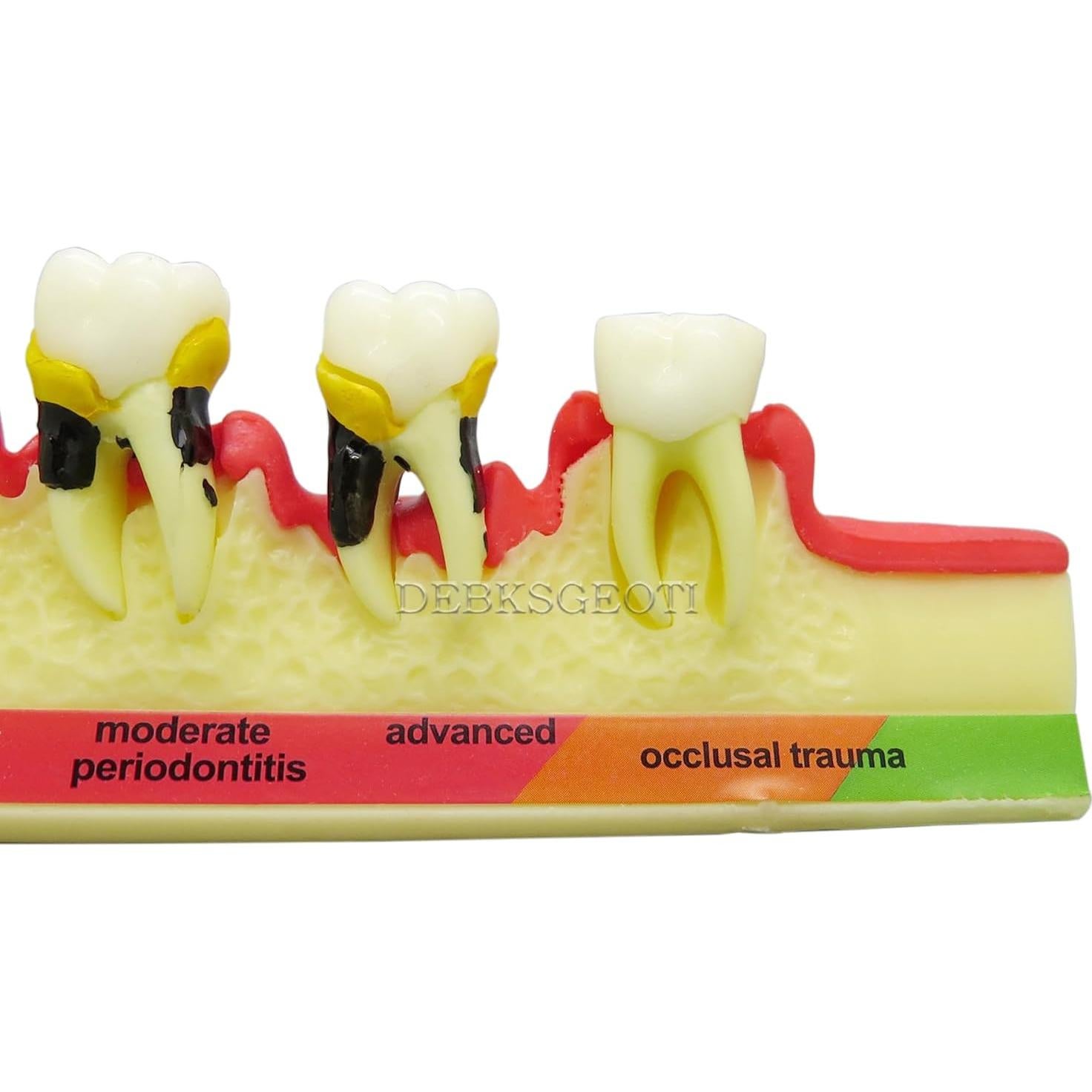 Modelo Typodont Dental M4010 para Enfermedad Periodontal