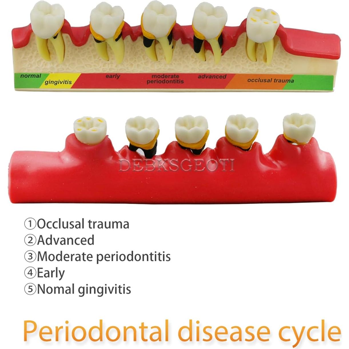 Modelo Typodont Dental M4010 para Enfermedad Periodontal