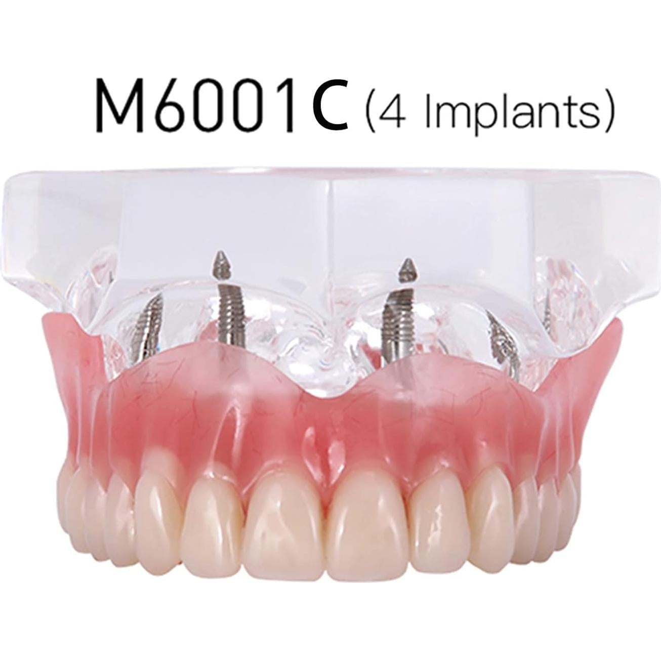 Modelo Typodont de Dientes de Implante Dental M6001 Claro