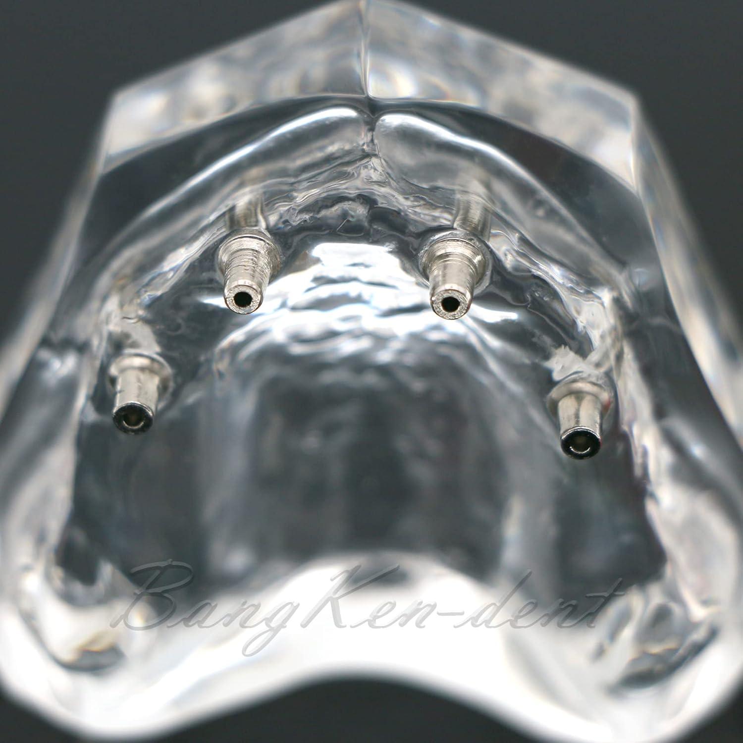 Modelo Typodont de Dientes de Implante Dental M6001 Claro