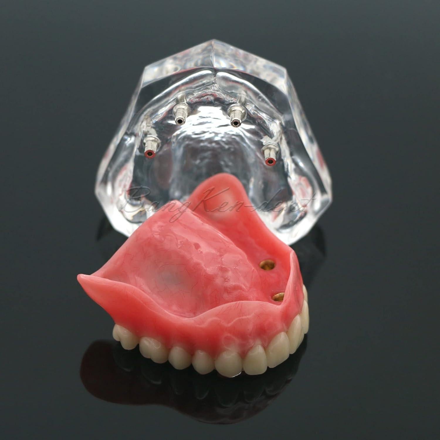 Modelo Typodont de Dientes de Implante Dental M6001 Claro