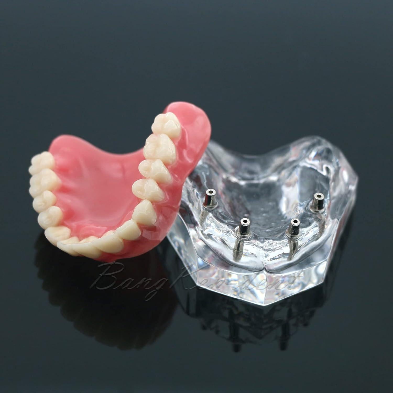 Modelo Typodont de Dientes de Implante Dental M6001 Claro