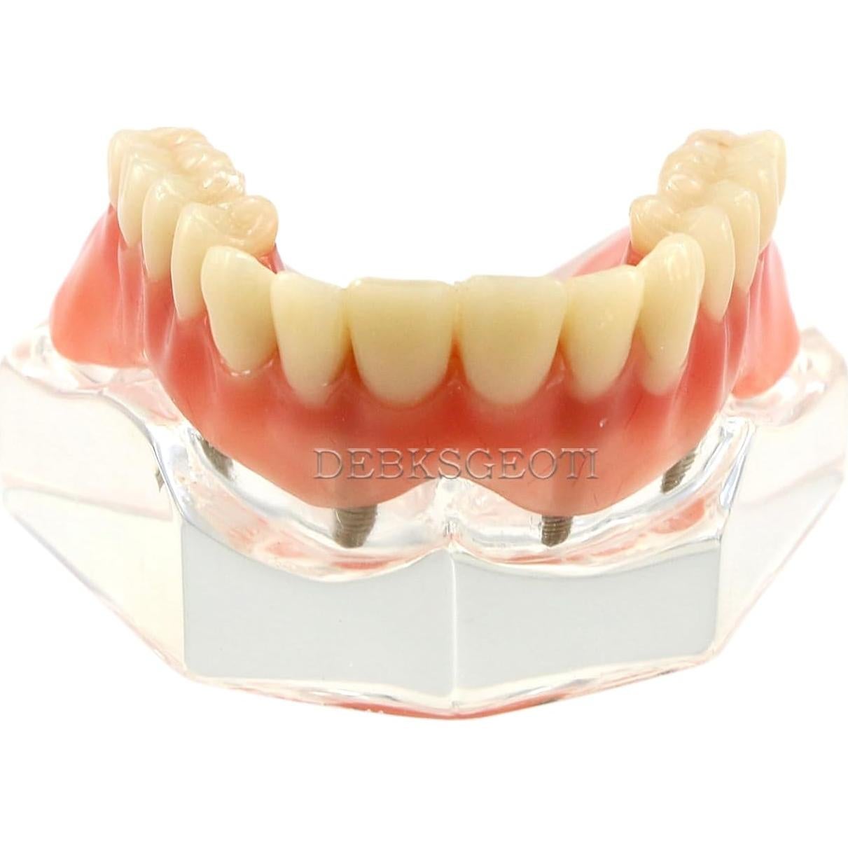 Modelo Typodont de Dientes de Implante Dental M6001 Claro