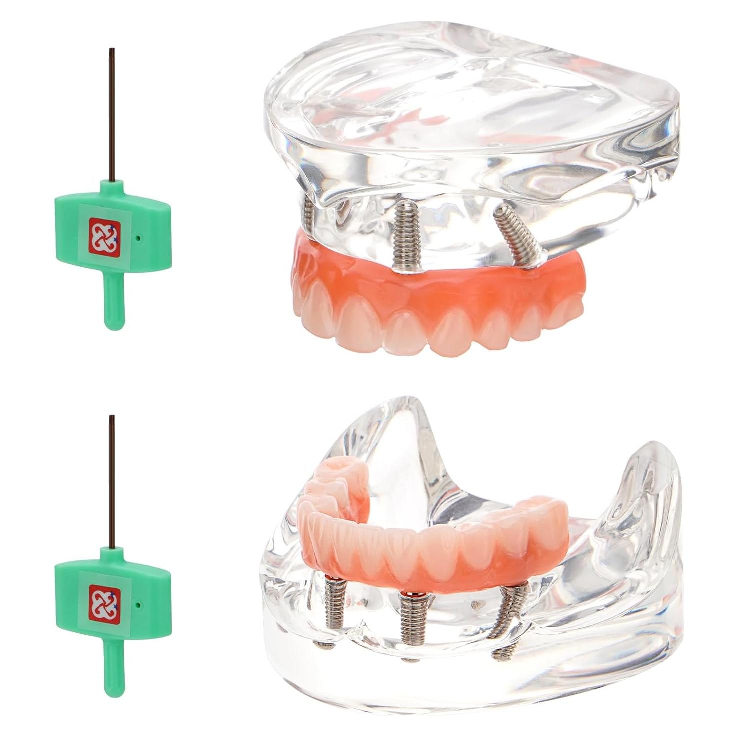 Implante Dental All-on-4 Guangzhou con Corona Removible