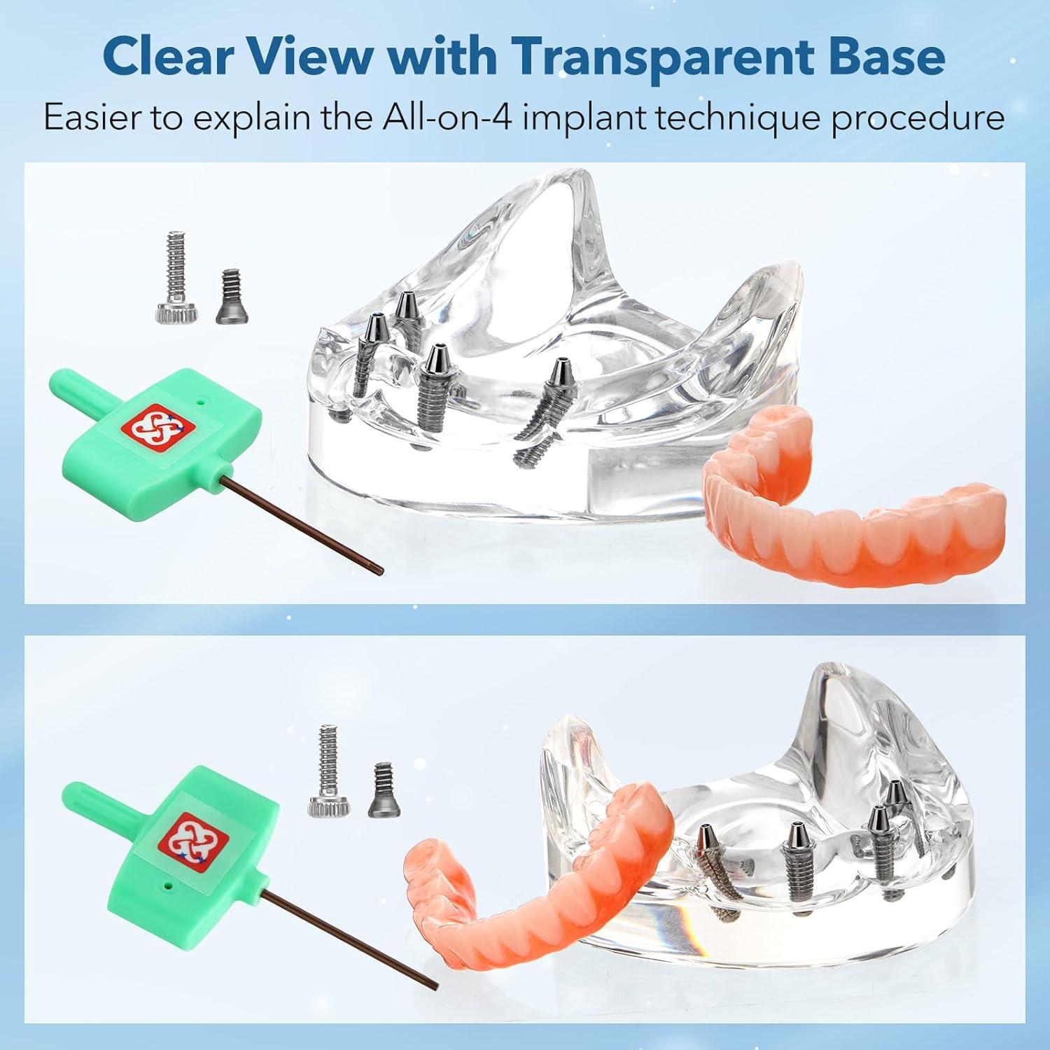 Implante Dental All-on-4 Guangzhou con Corona Removible