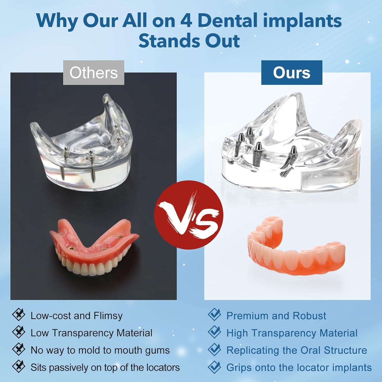 Implante Dental All-on-4 Guangzhou con Corona Removible