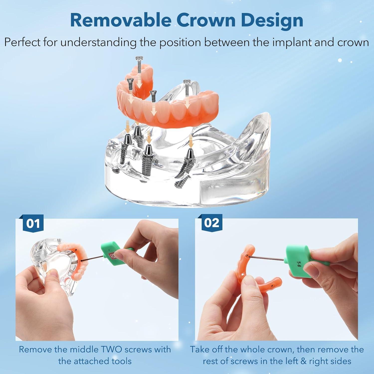 Implante Dental All-on-4 Guangzhou con Corona Removible