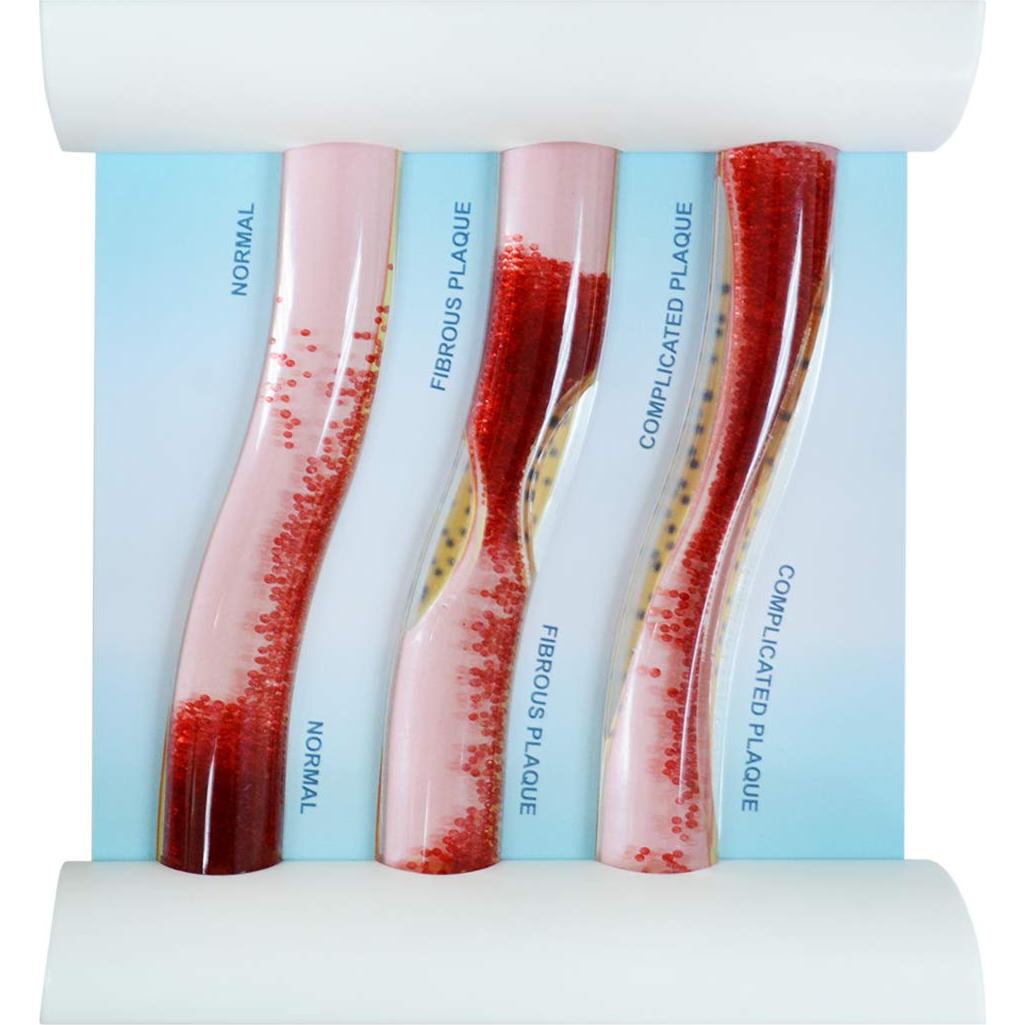 Modelo de vaso sanguíneo LDL SimCoach para enseñanza médica