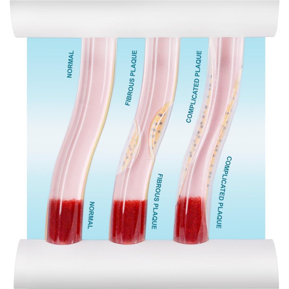 Modelo de vaso sanguíneo LDL SimCoach para enseñanza médica