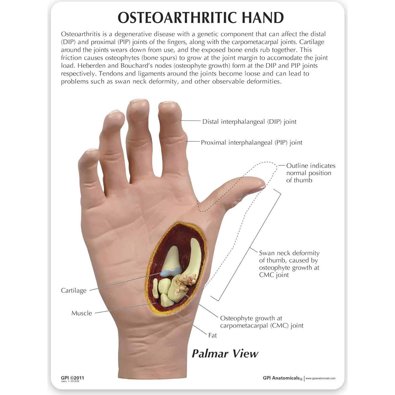 Modelo de Mano Derecha con Osteoartritis GPI Anatomicals