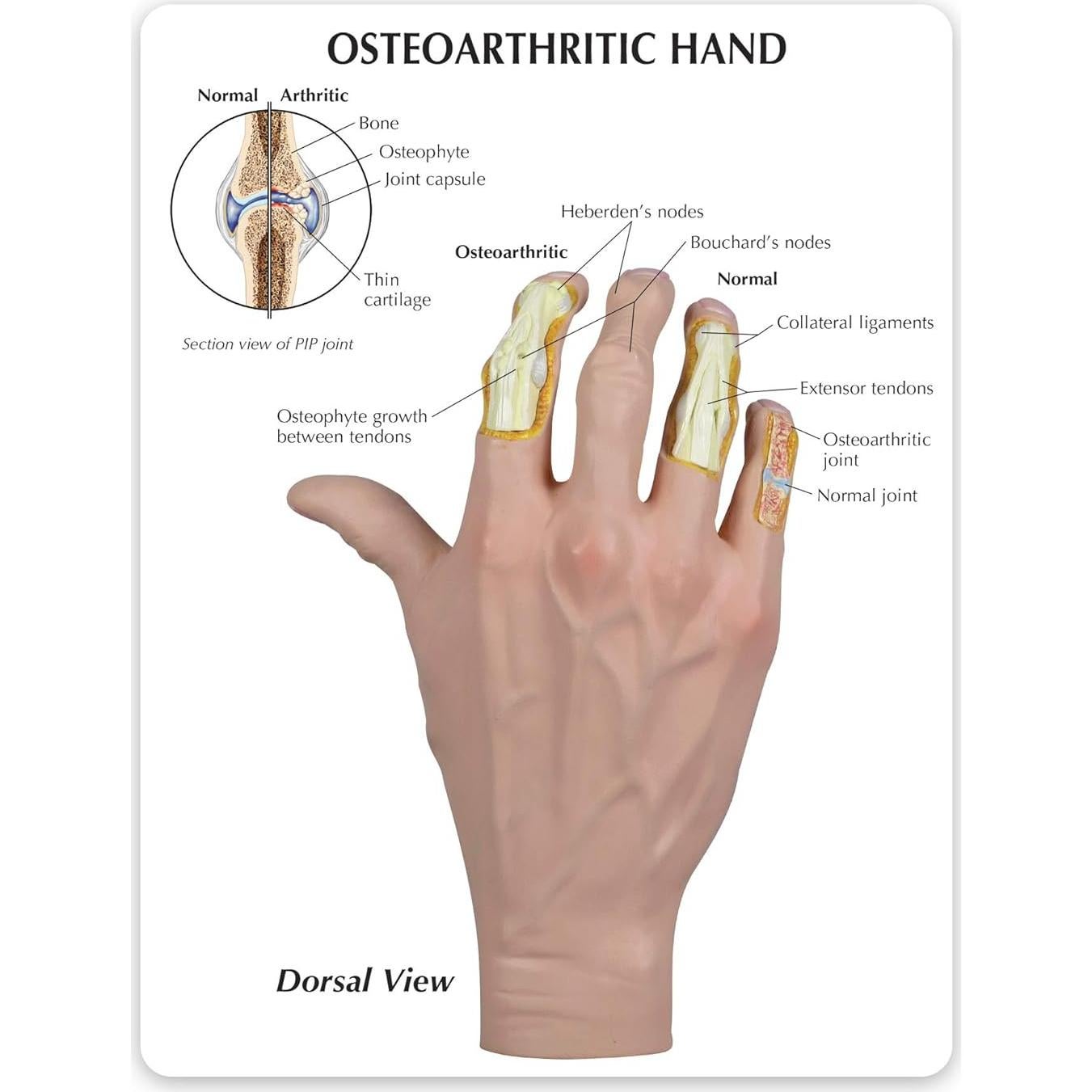Modelo de Mano Derecha con Osteoartritis GPI Anatomicals