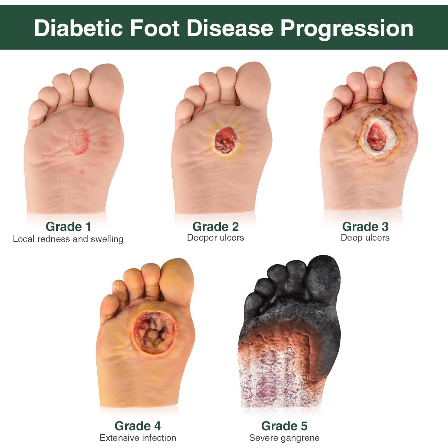 Modelo de Cuidado del Pie Diabético 5 Pcs Ultrassist
