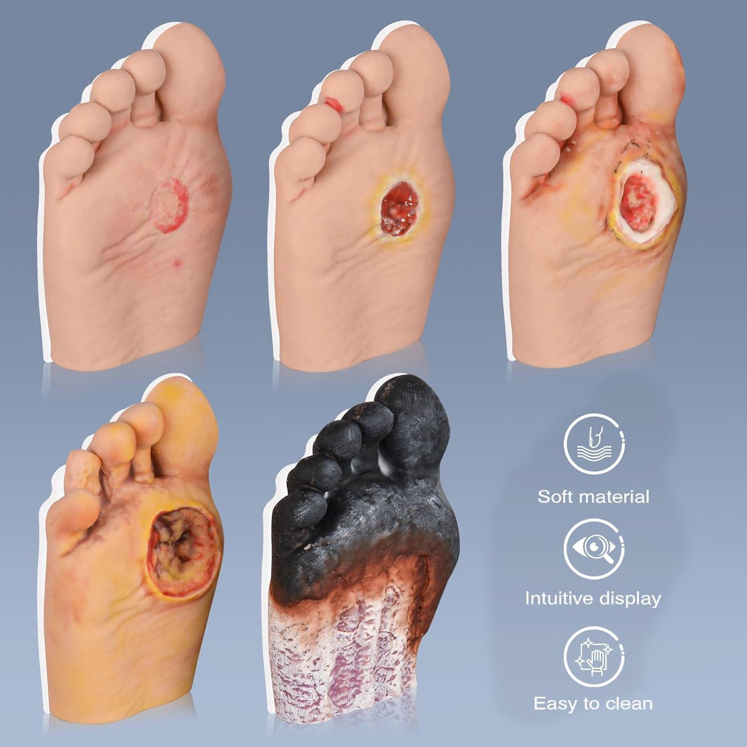 Modelo de Cuidado del Pie Diabético 5 Pcs Ultrassist