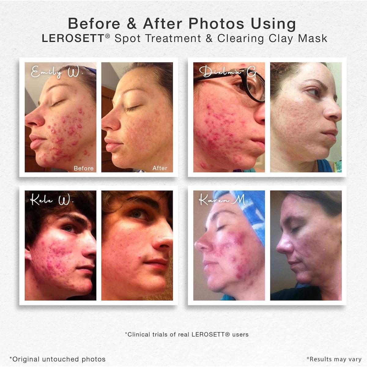 Mascarilla Facial de Arcilla LEROSETT 85g - Tratamiento Acné