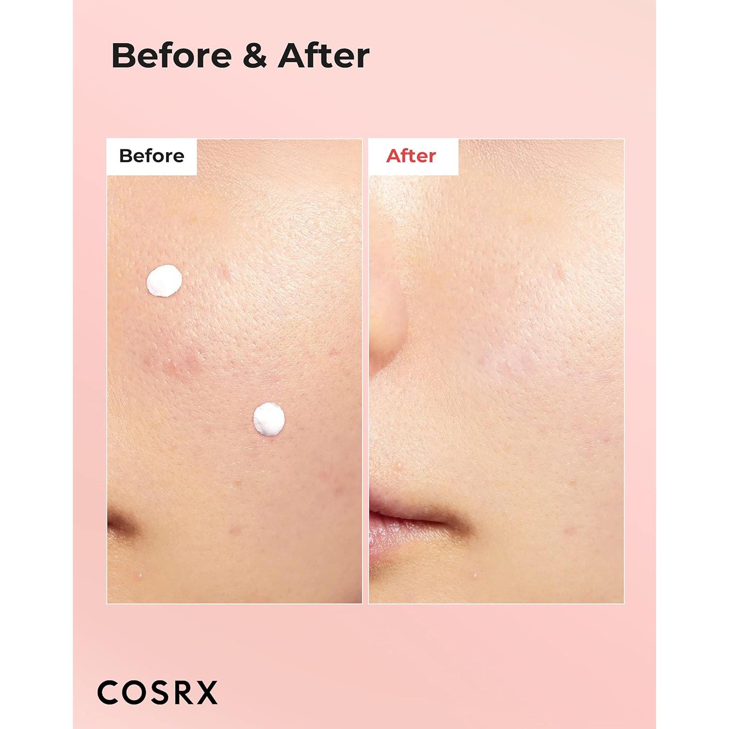 Loción Secante para Manchas de Acné COSRX 30ml