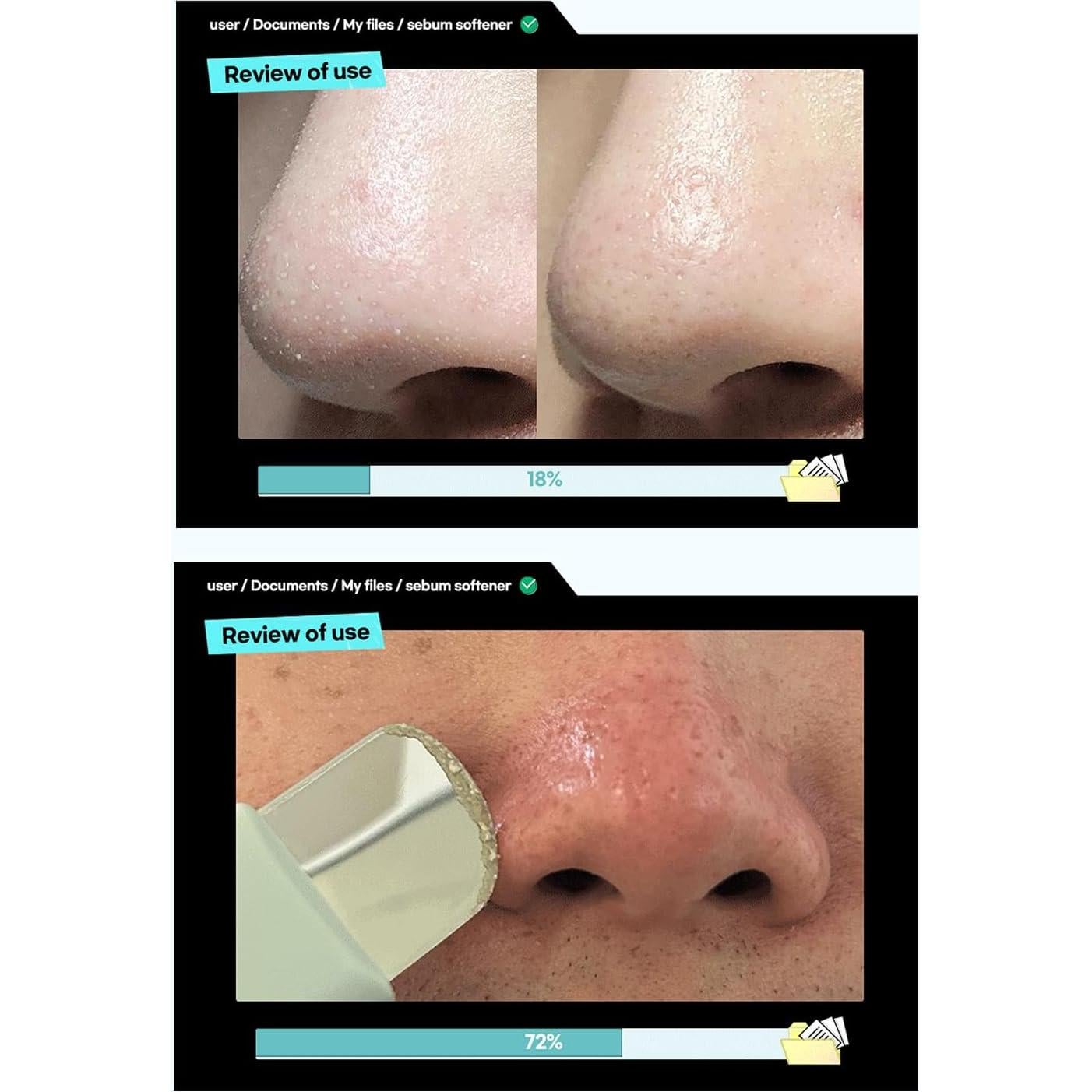 ILSO Super Derretidor de Sebo 191g - Limpieza de Poros Efectiva