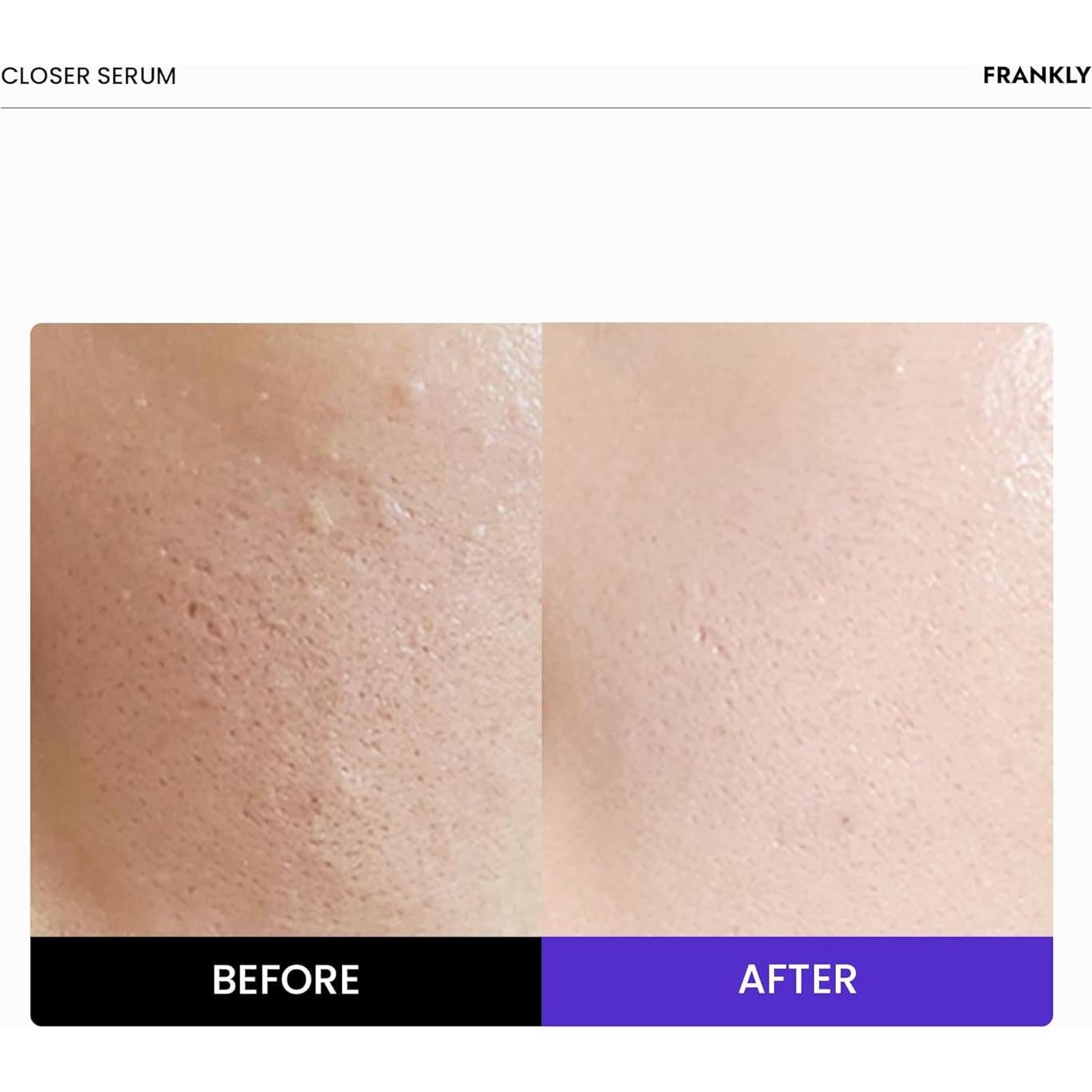 Suero Closer Frankly 30 ml | Minimizador de Poros Vegano