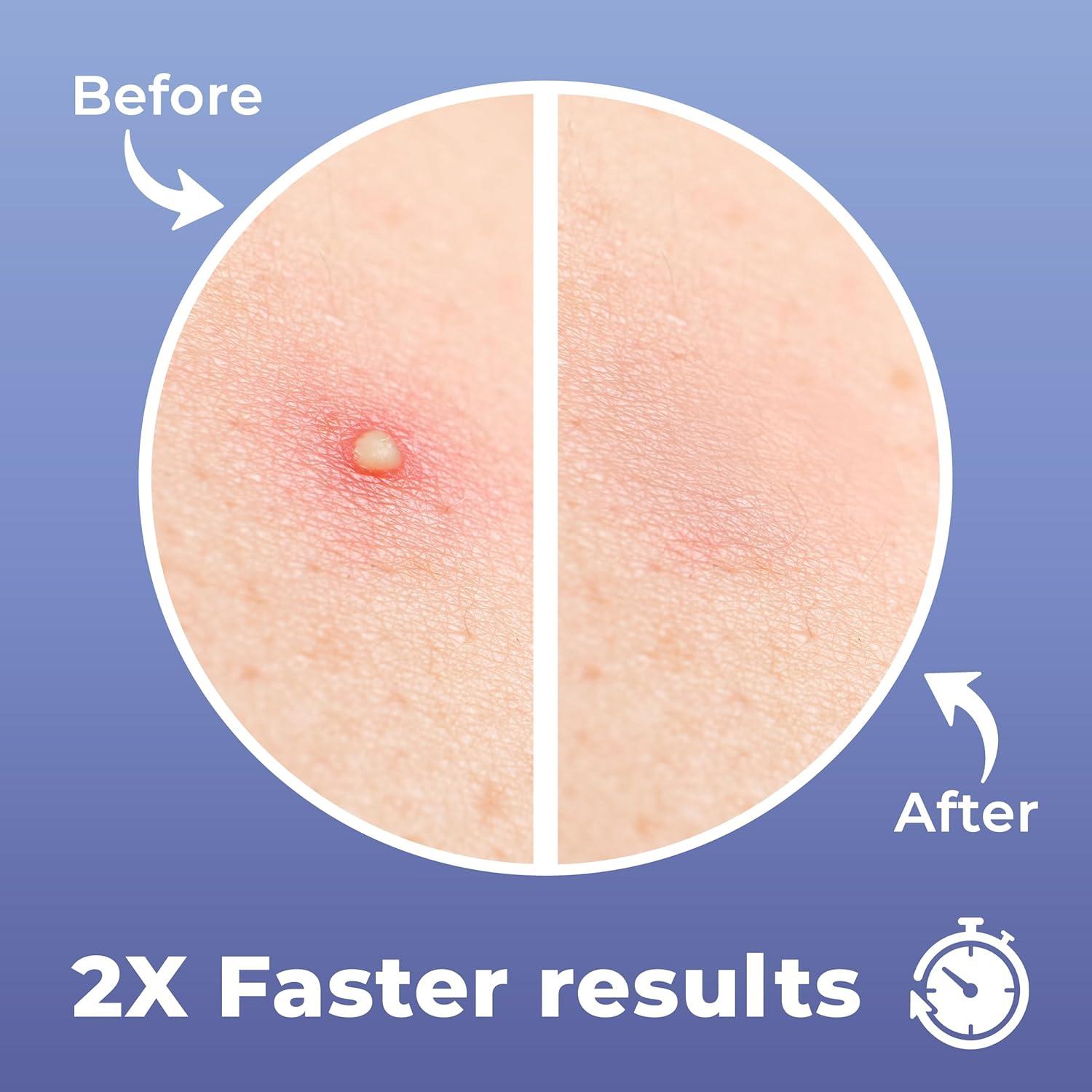 Parche para Granos Hydrocolloid PatchRx - 120 Unidades con Aceite de Árbol de Té