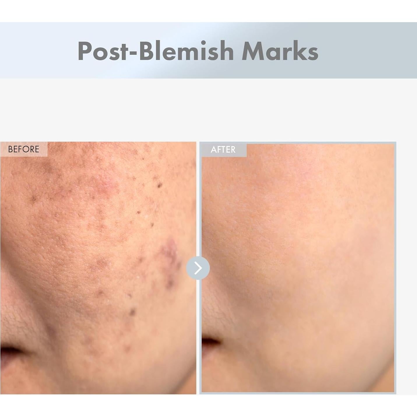 Suero Facial Niacinamida 15% MANTONG 30ml Piel Radiante