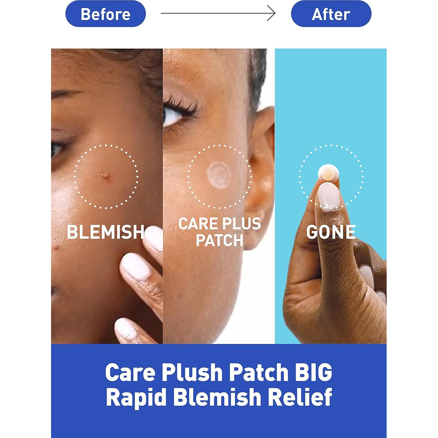 Parche para Acné Hidrocoloide OLIVE YOUNG 306 Unidades