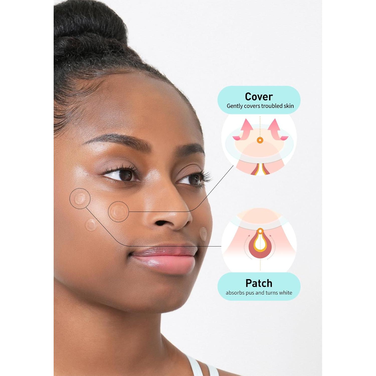 Parche para Acné Hidrocoloide OLIVE YOUNG 306 Unidades