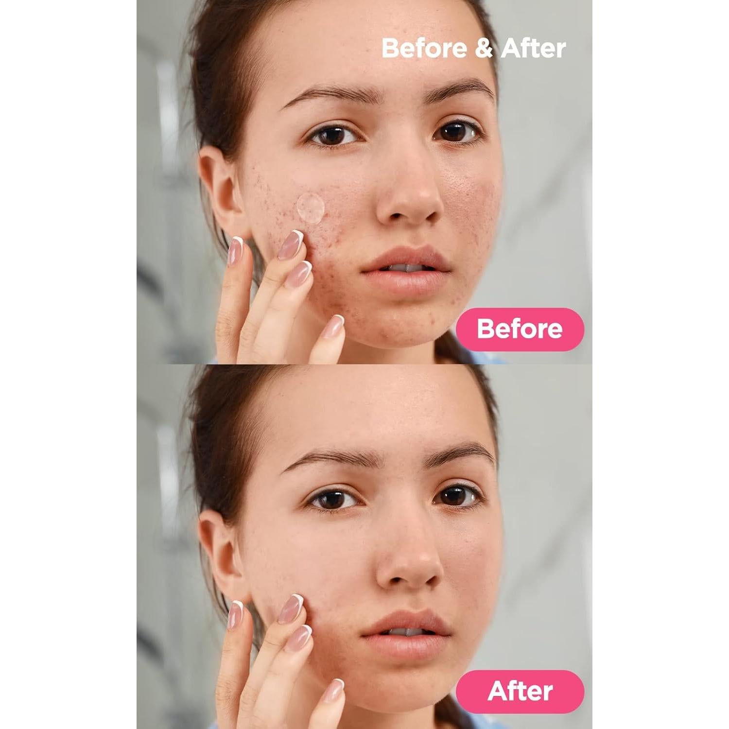 Parches Hidrocoloides NEOGEN A-CLEAR 12 Unidades