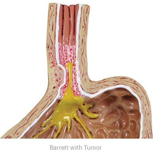 Modelo Estómago GERD GPI ANATOMICALS 10.16cm para Educación Médica
