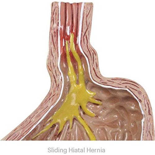 Modelo Estómago GERD GPI ANATOMICALS 10.16cm para Educación Médica