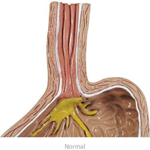 Modelo Estómago GERD GPI ANATOMICALS 10.16cm para Educación Médica