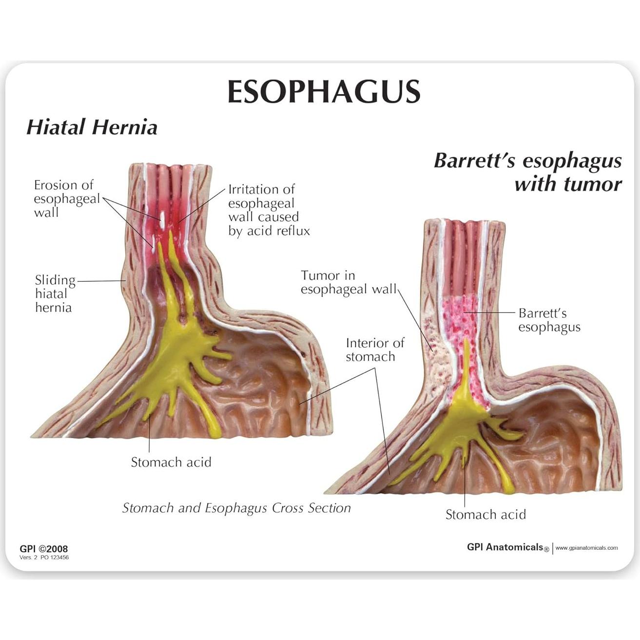 Modelo Estómago GERD GPI ANATOMICALS 10.16cm para Educación Médica