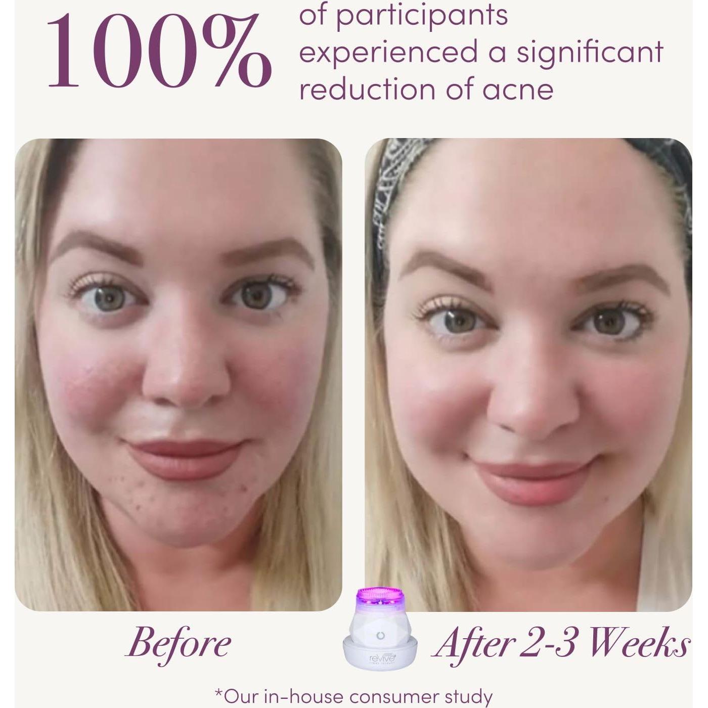 reVive Light Therapy Soniqué Mini Acne Cleanser, Battery-Operated Sonic Face Cleanser Brush with Blue & Red Light Therapy, Medical-Grade Acne Device for Face & Body, Water-Resistant