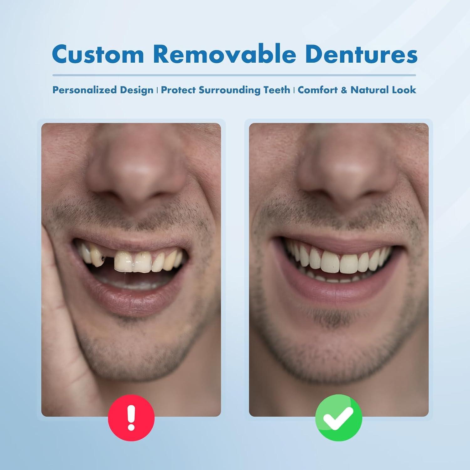 Dentaduras Removibles Personalizadas Qiivosm - 1 Diente