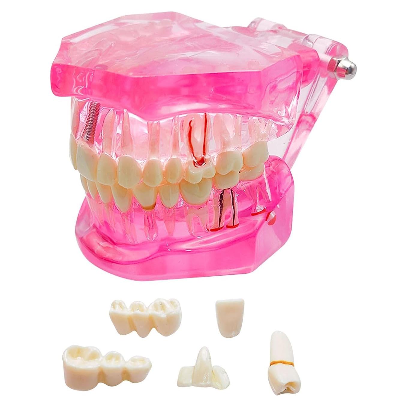 Modelo Dental Removible Windplusya con Implantes y Puente Rojo