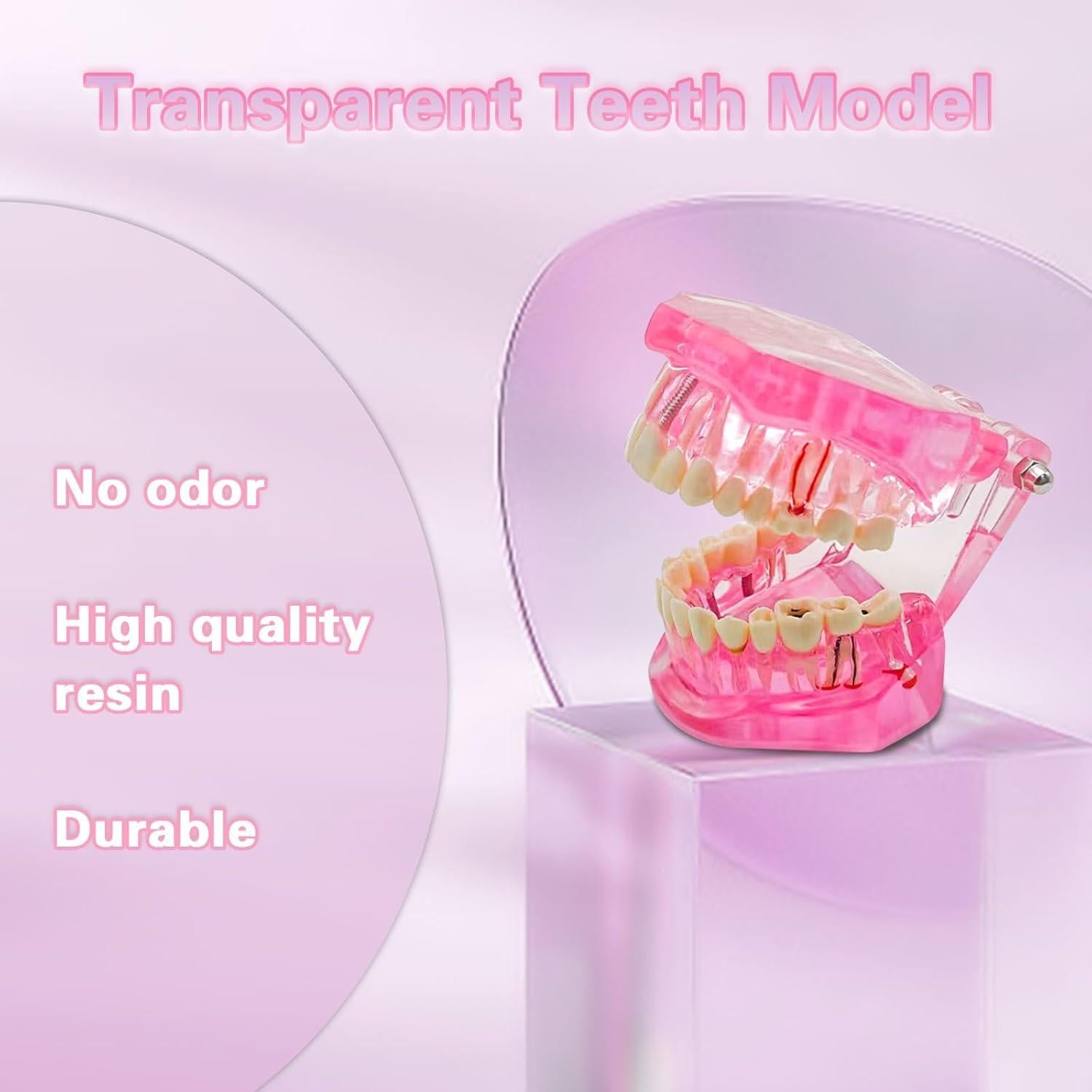 Modelo Dental Removible Windplusya con Implantes y Puente Rojo