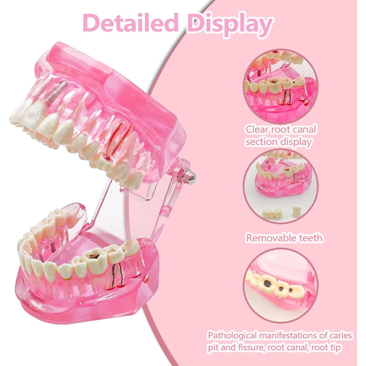 Modelo Dental Removible Windplusya con Implantes y Puente Rojo