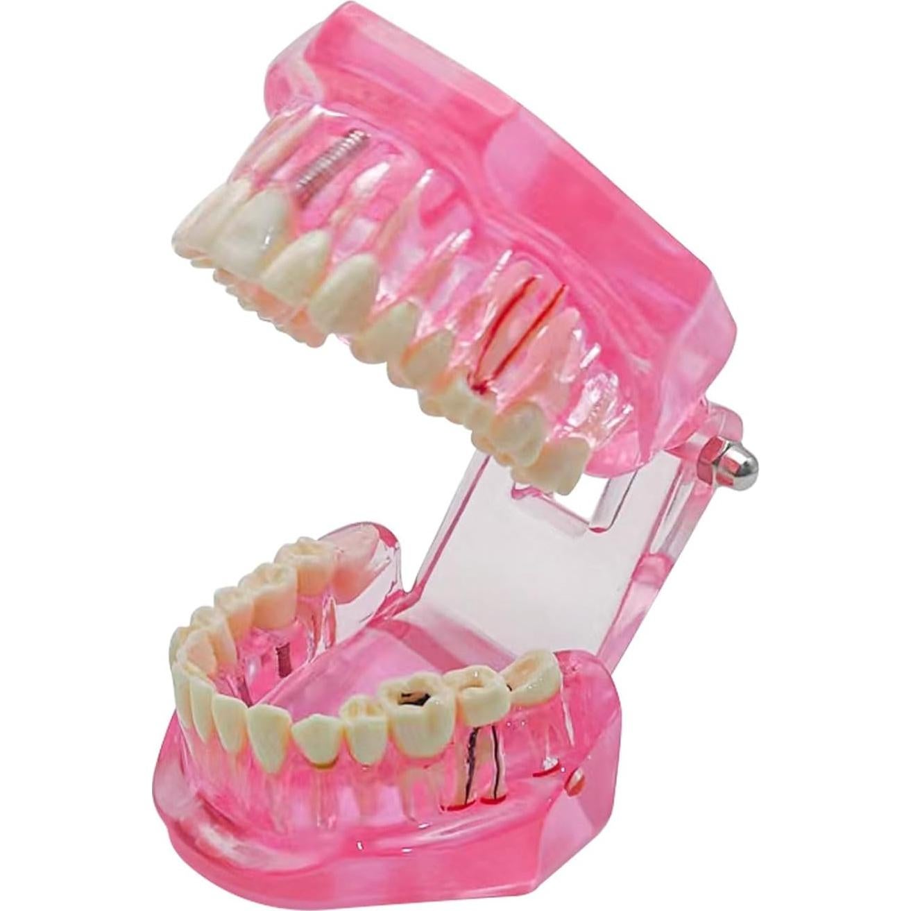 Modelo Dental Removible Windplusya con Implantes y Puente Rojo