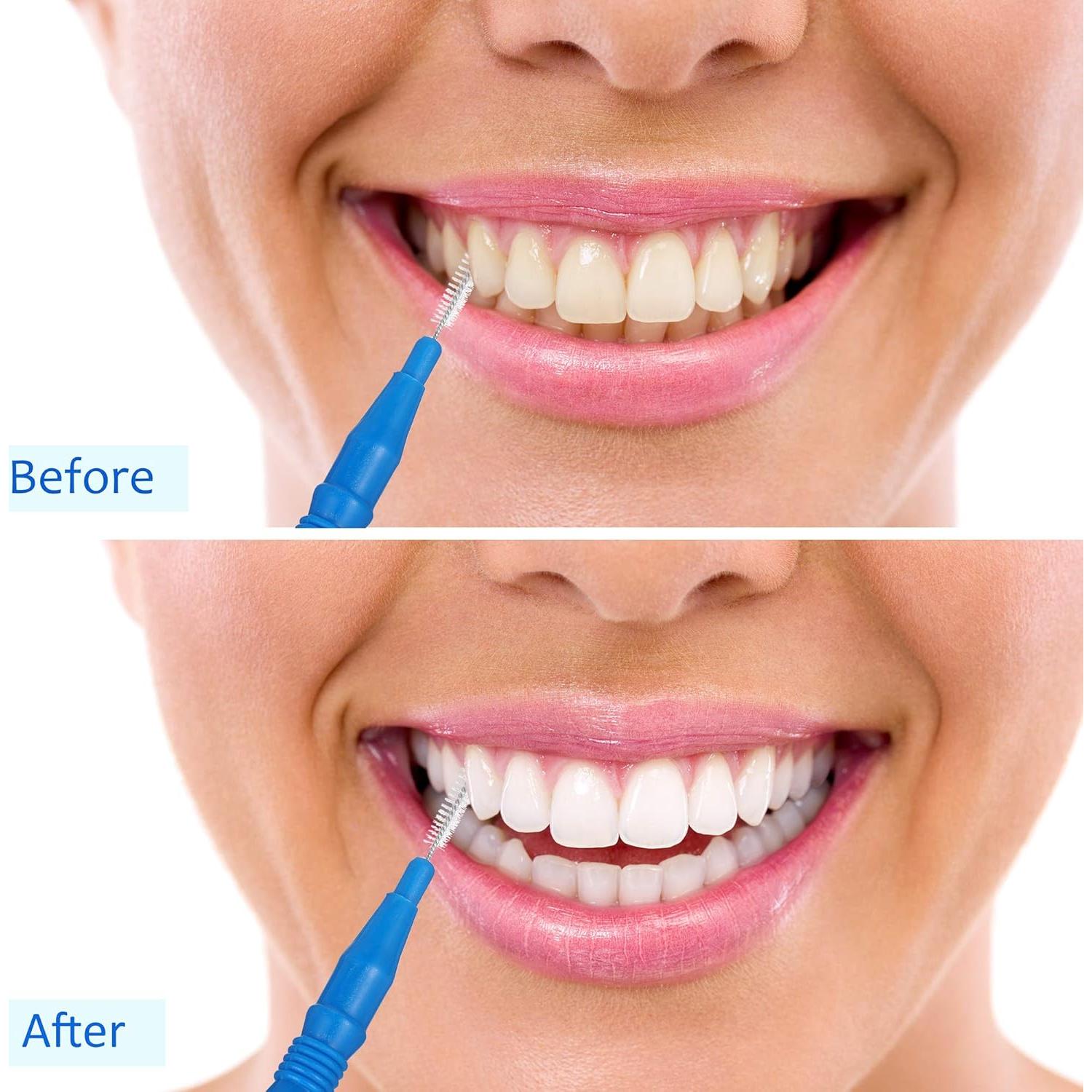 BBTO 100 Piezas Cepillos Dentales Interdentales para Brackets