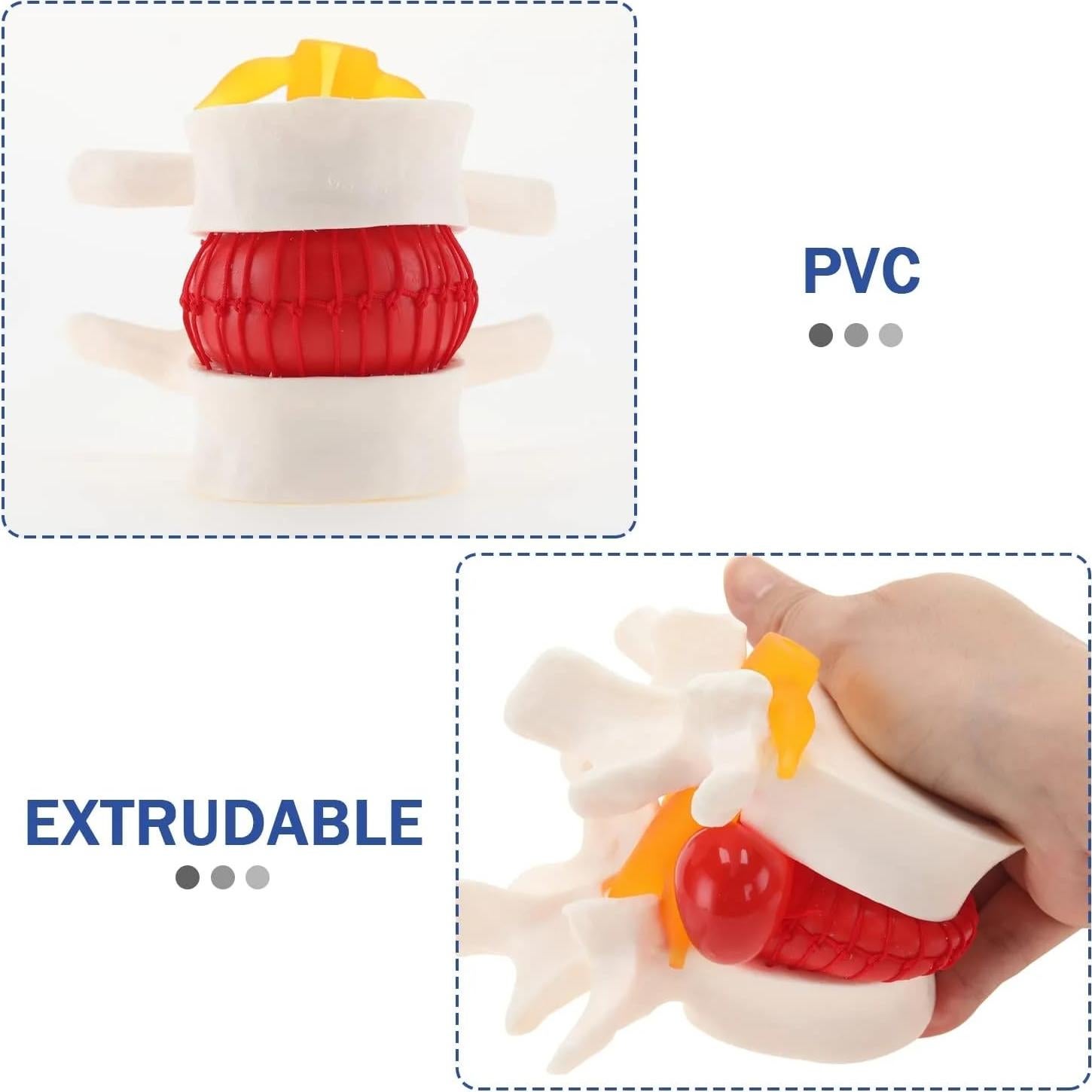 Modelo de Herniación del Disco Lumbar LYOU - 10x10 cm